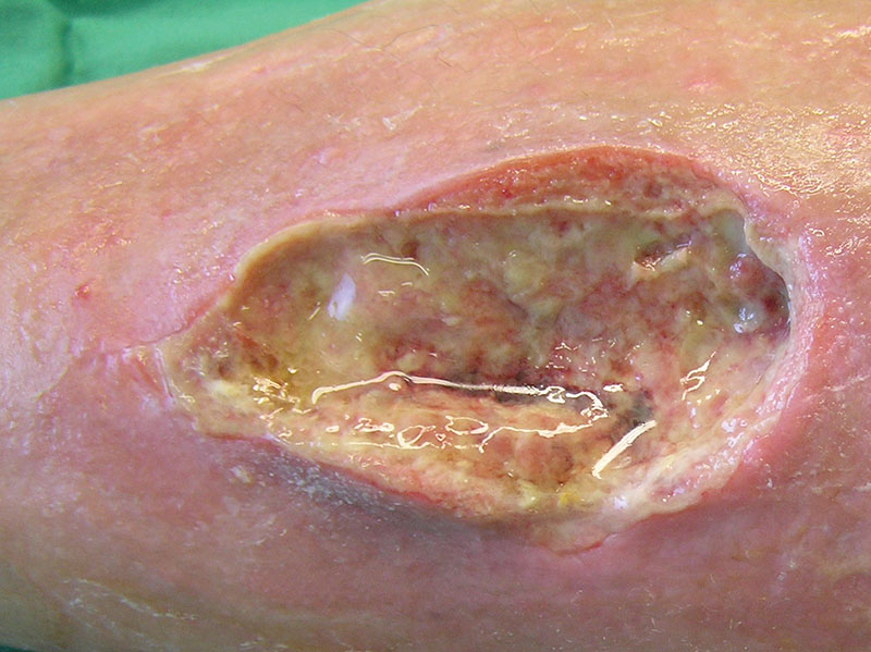 Exsudats et espaces morts